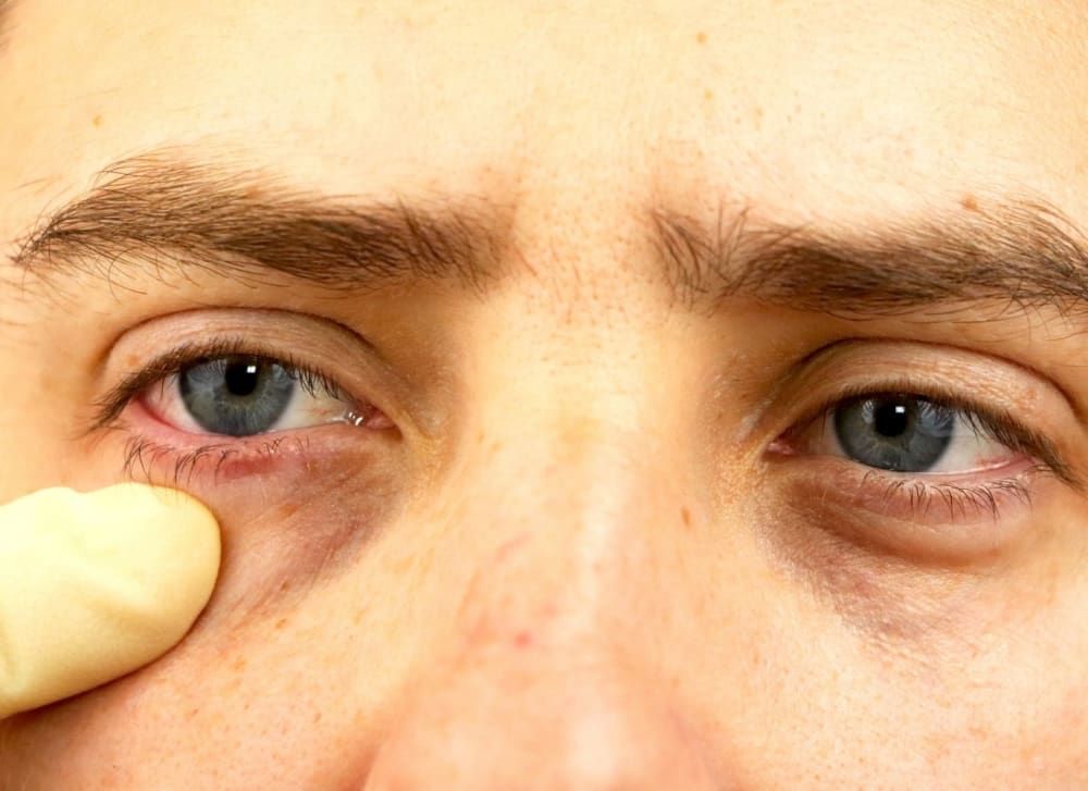 sunken-eyes-causes-pictures-and-how-to-get-rid-of-them